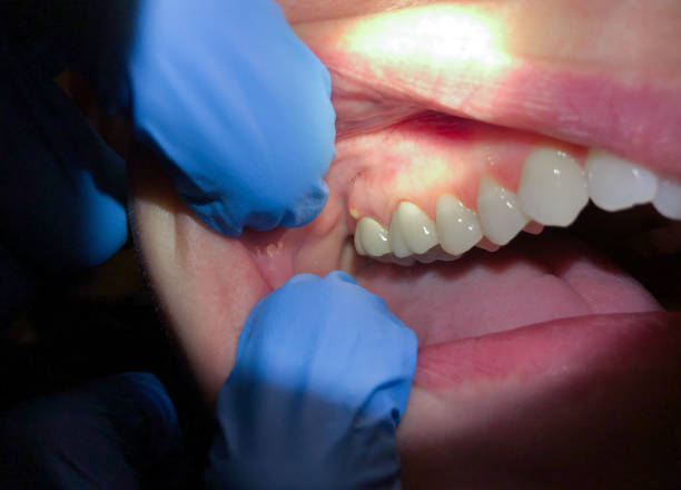 Best Emergency Broken Tooth Repair in Zephyrhills South, FL